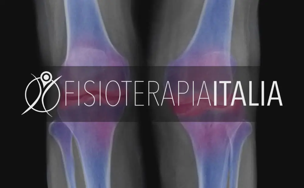 Artrosi soluzioni per il dolore, Fisioterapia ed Esercizi