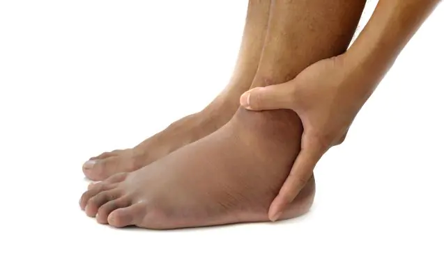 Trattamento di edema post-traumatico: linfodrenaggio