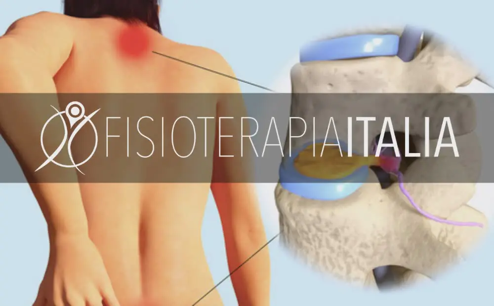 La differenza tra ernia cervicale, lombare e dorsale