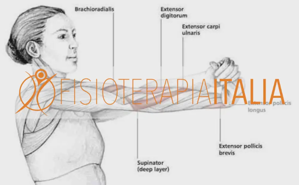 Esercizi per l'Epicondilite