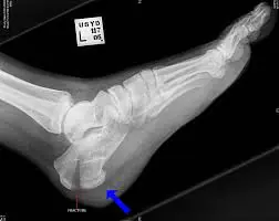 Frattura al calcagno il trattamento e la terapia fisioterapi...