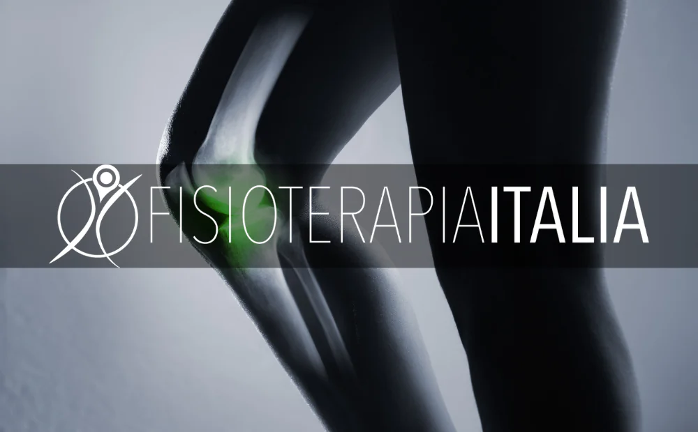 Ginocchio varo, cause ed esercizi per ridurre il problema