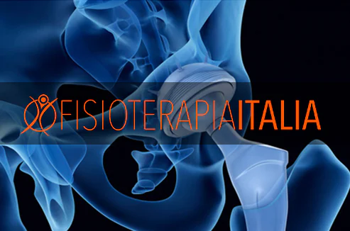 La protesi all’anca e la riabilitazione: tornare in piedi è...