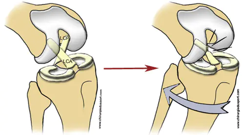 Trattamento fisioterapico per la lesione del legamento croci...
