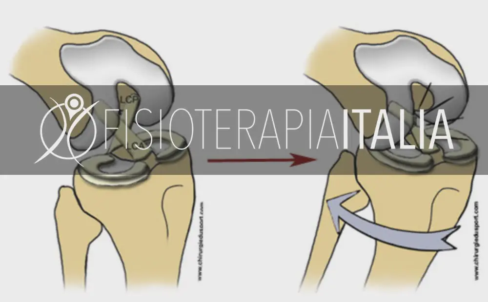 Rottura crociato ginocchio: quando operarsi e la riabilitazi...