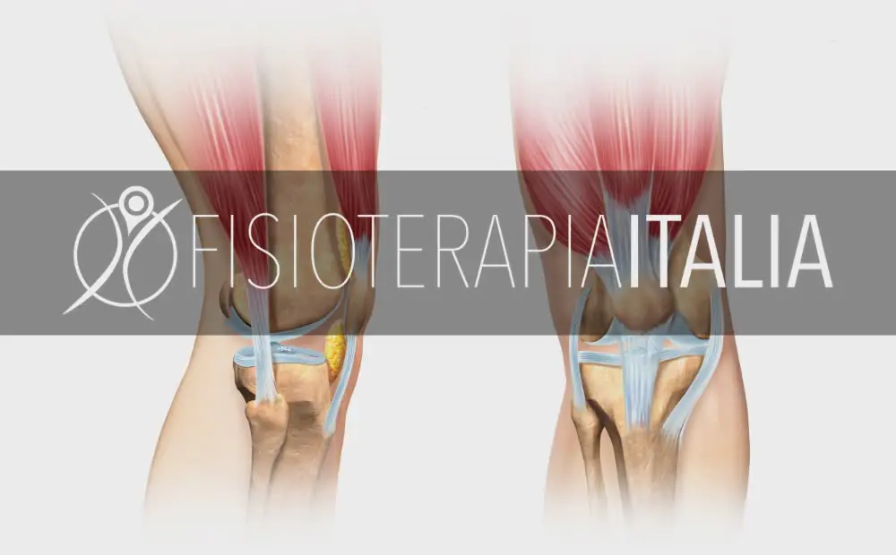 Meniscosi cure e rimedi per il dolore al ginocchio