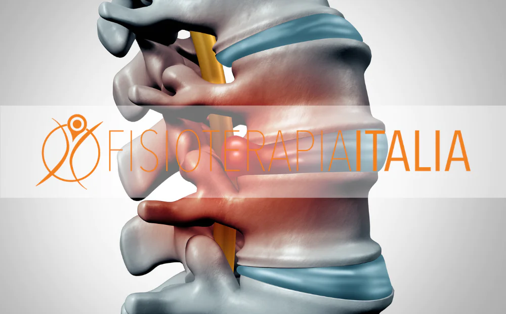 Nervo sciatico Infiammato Cause e Rimedi per la sciatica