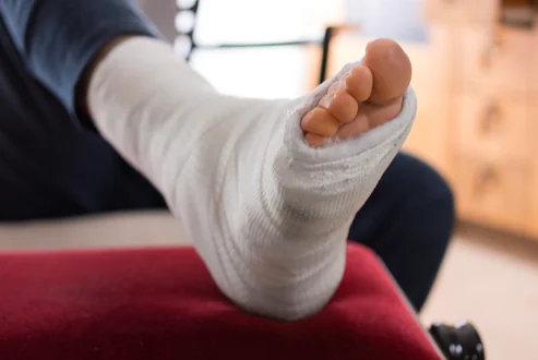 I migliori esercizi da fare dopo un'ingessatura del piede