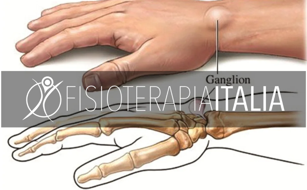 Cosa fare se abbiamo una cistetendinea al polso