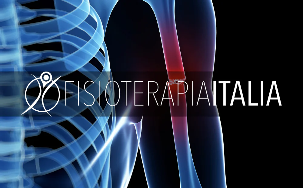 Pseudoartrosi: quando una frattura ossea non si salda