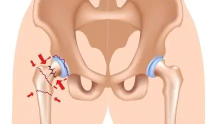 Frattura anca come si cura con la fisioterapia