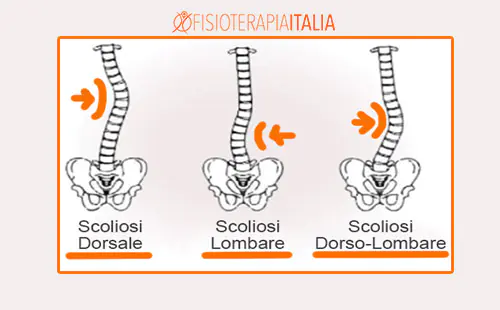 La scoliosi