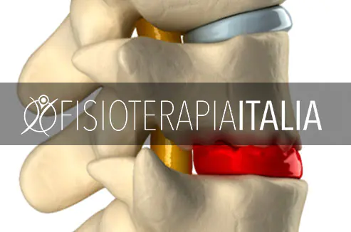 Spondiloartrosi, sintomi e cura