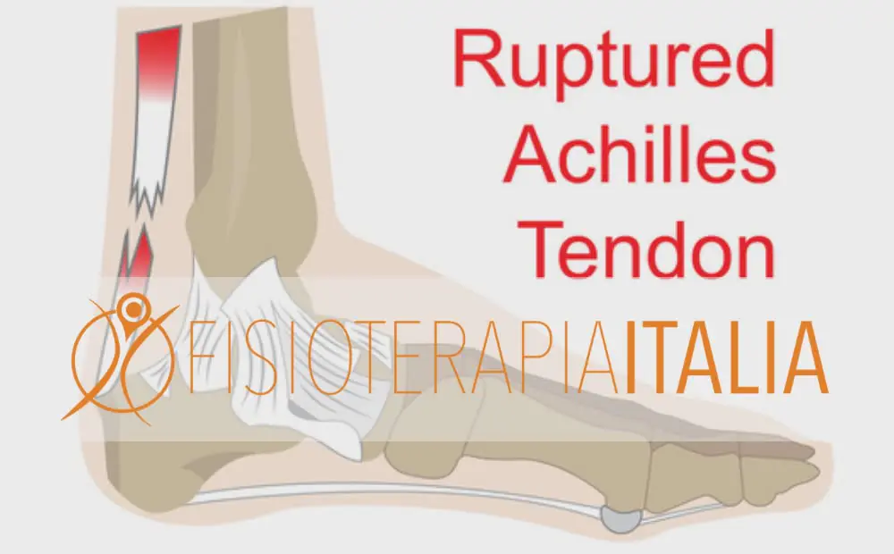 Tendinopatia al tendine d'Achille, prevenzione e cura