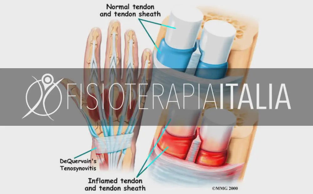 Tendinite al polso come curarla e riconoscerla